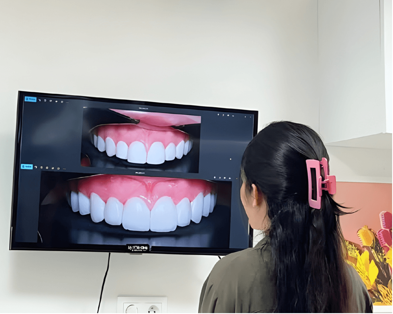Simulation numérique du sourire avant et après facettes